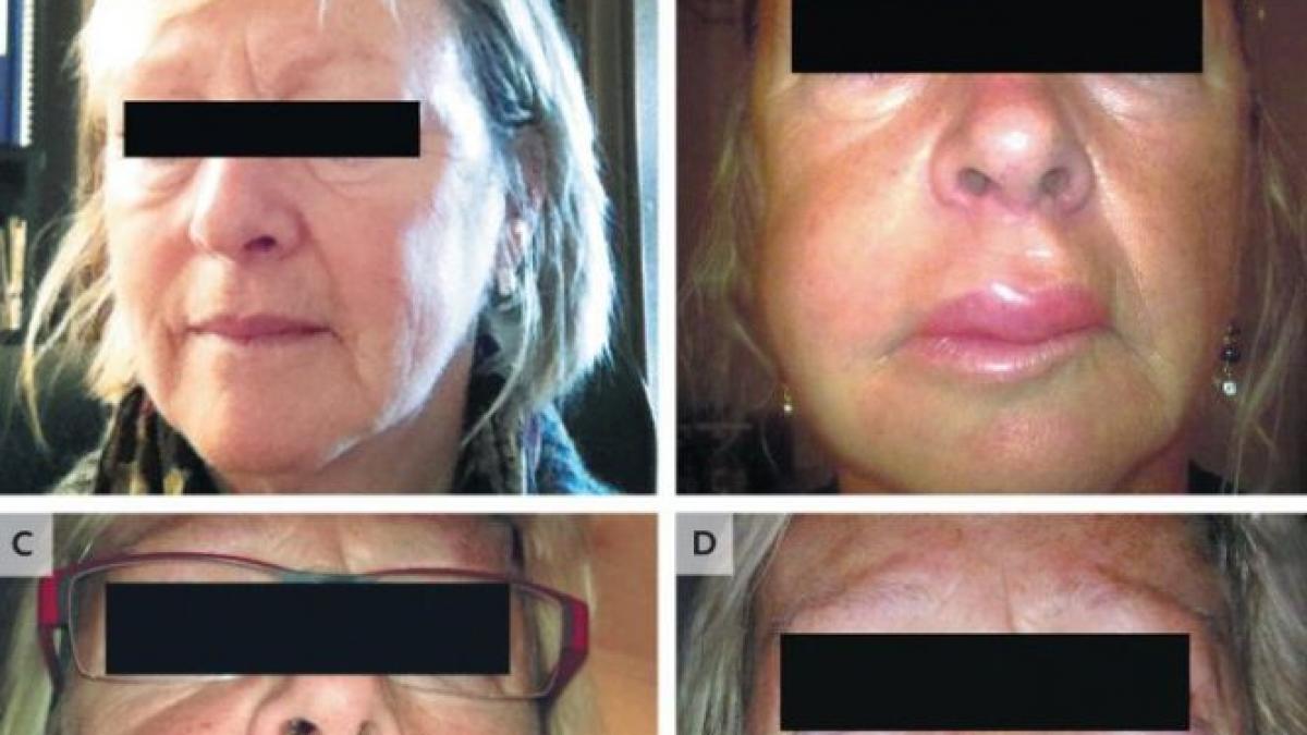 boala rara care daca nu te ucide te mutileaza in doar cateva minute in romania ar exista sute de