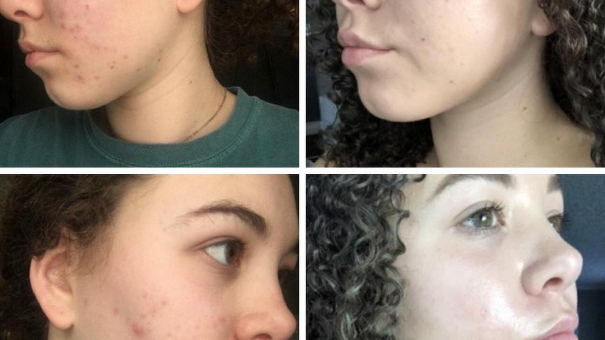 pustoaica asta a scapat de acnee in doar patru luni folosind produse pe care le ai si tu in casa