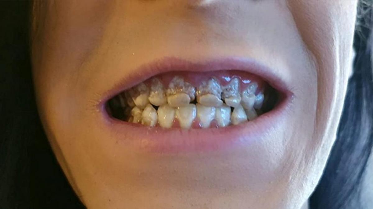 ani la rand a avut acest obicei si a ajuns sa arate asa dentistul s a ingrozit cand l a vazut mi a