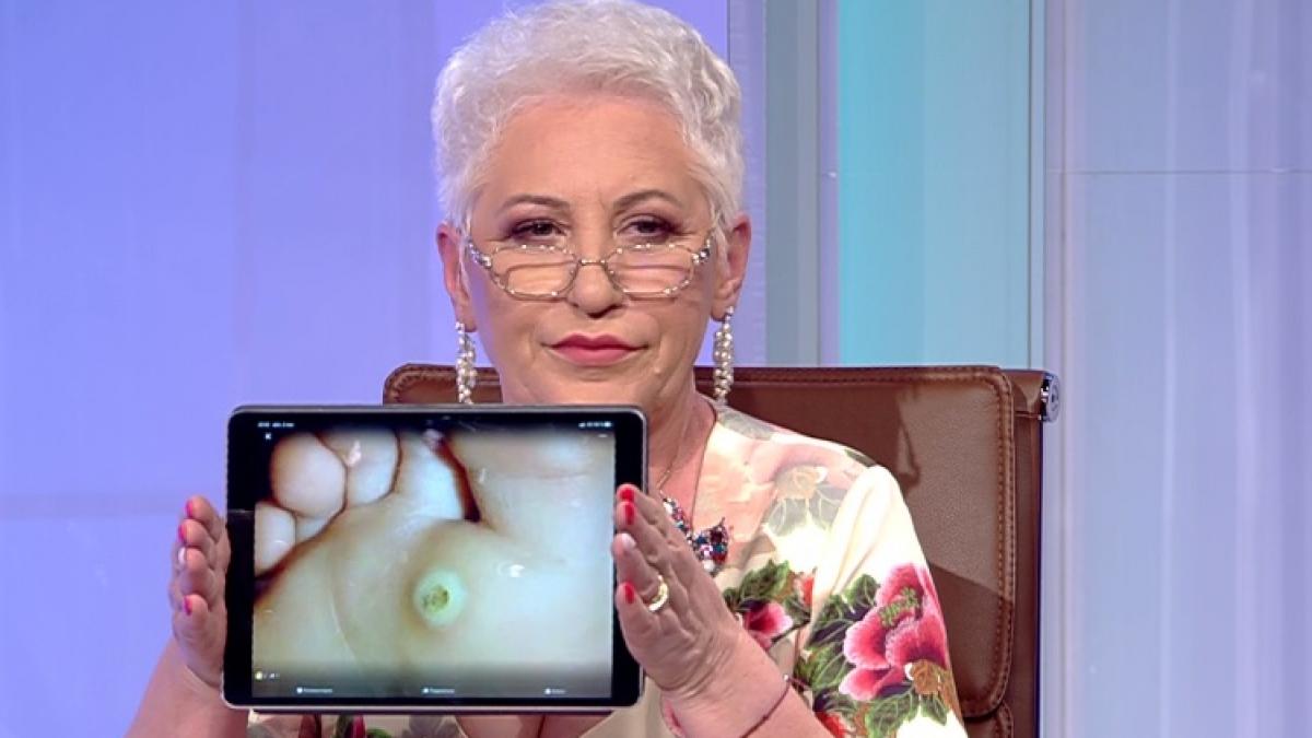 leacul zilei cu lidia fecioru tratament naturist pentru bataturi si negi