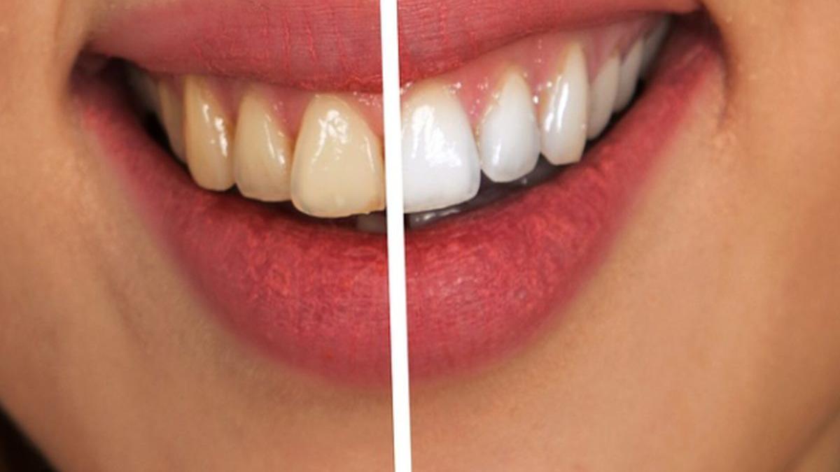 cum sa ai dinti mai albi trucul pe care sigur nu il stiai