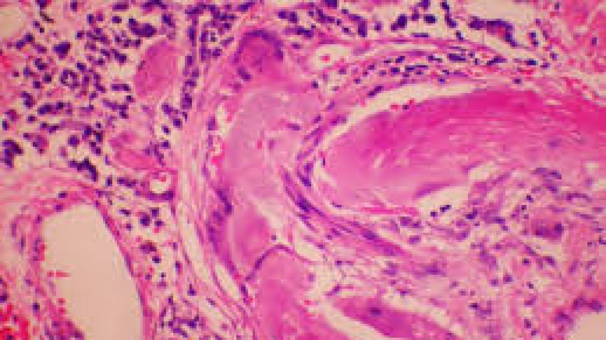 o boala ereditara grava bantuie un sat din romania medicii cauta de urgenta solutii