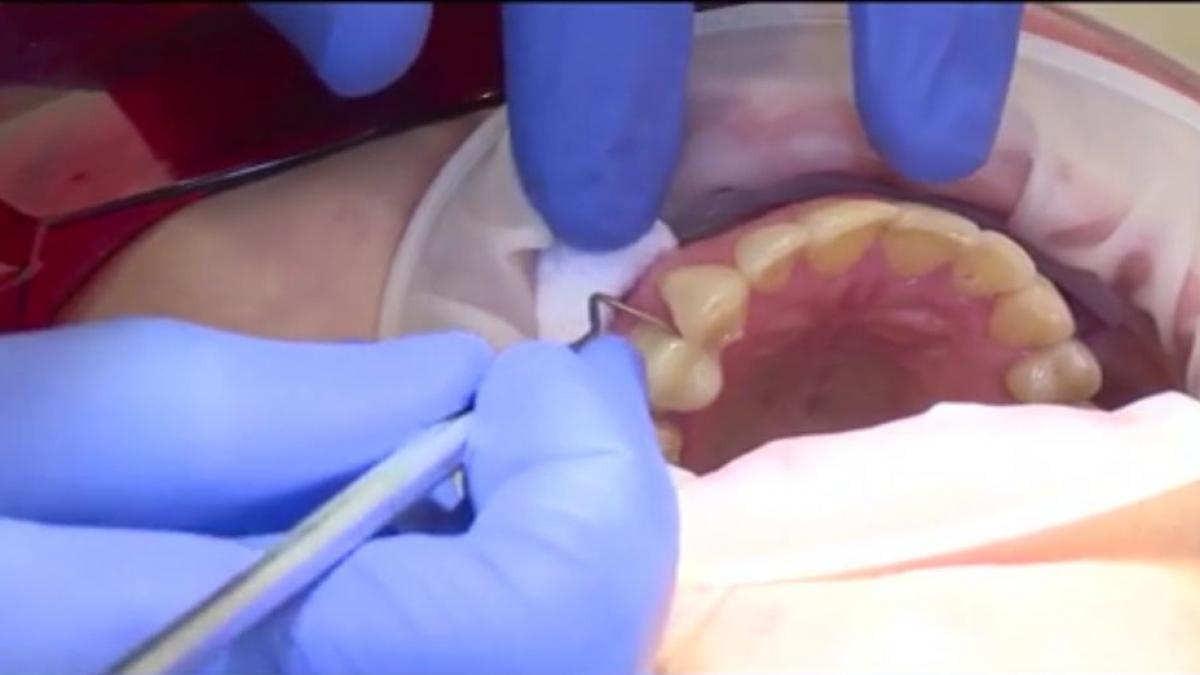 numai de bine tot ce trebuie sa stii despre fatetele dentare