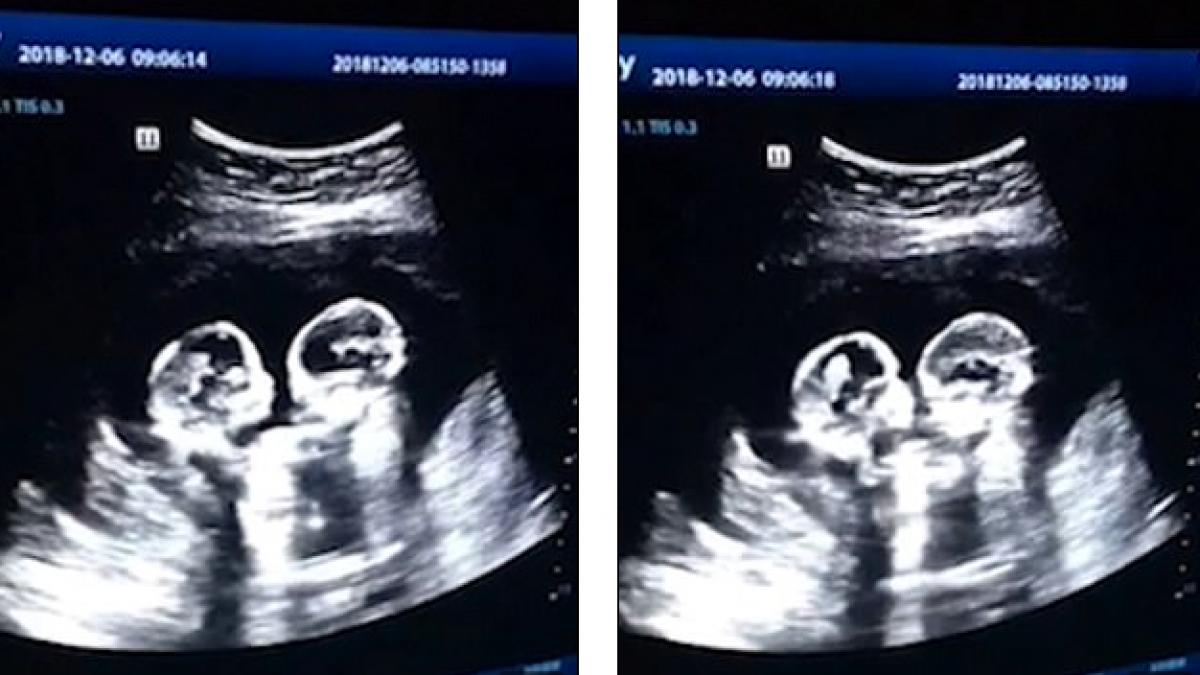 mama a mers la o ecografie era gravida cu gemene ce a vazut medicul a facut inconjurul lumii asa