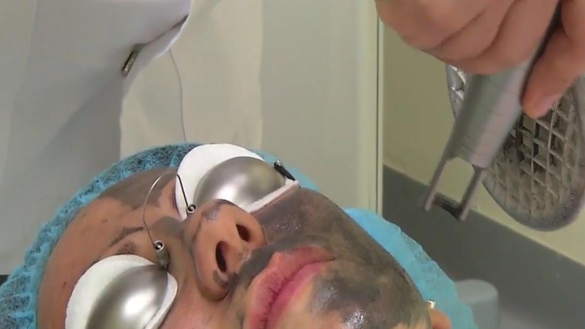 numai de bine peeling un cu laser carbon tratamentul pentru un ten perfect