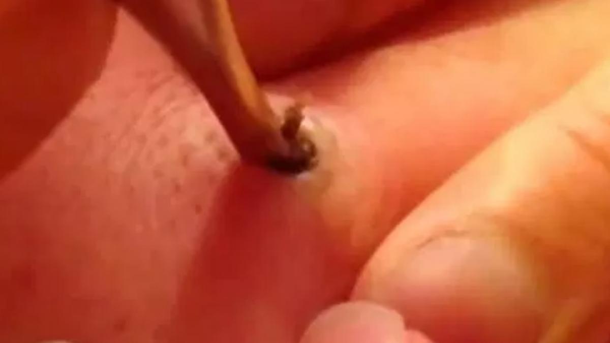 a tras cu penseta de un punct negru de pe piele vechi de 25 de ani imagini care va pot afecta