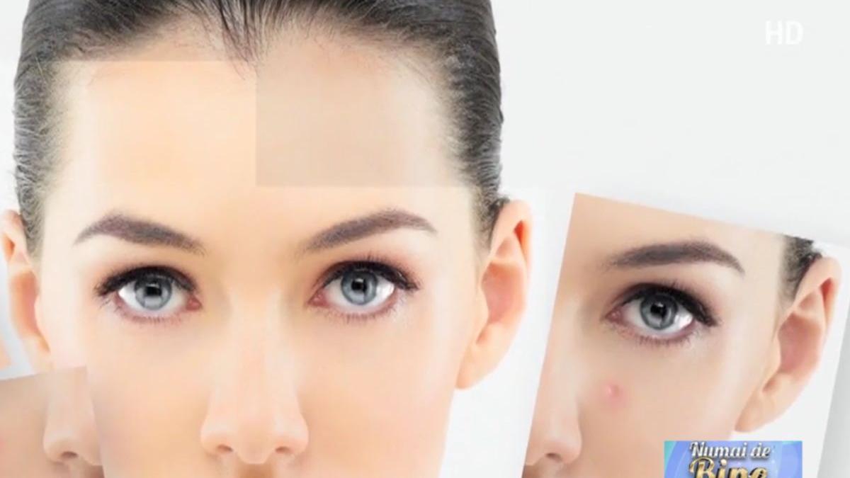 numai de bine sfaturi impotriva acneei