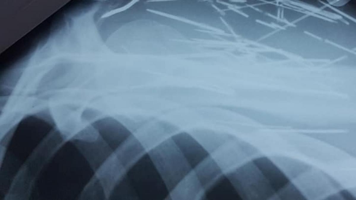 barbatul din botosani se plangea ca nu se simte bine asa ca a fost dus la spital medicii au