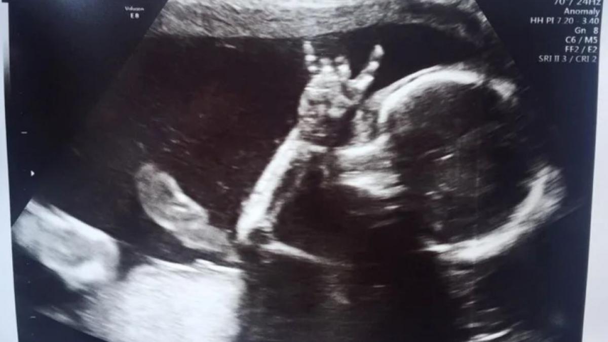 parintii au fost uimiti cand au vazut ce face fetita lor nenascuta in ecografii dupa 18 luni ceva
