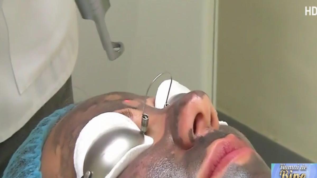 numai de bine procedura de peeling unica fara durere si fara recuperare