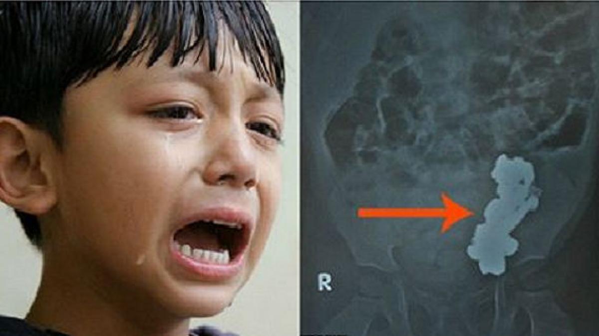 micutul a inceput sa aiba dureri groaznice de stomac medicii au fost socati la radiografie parintii