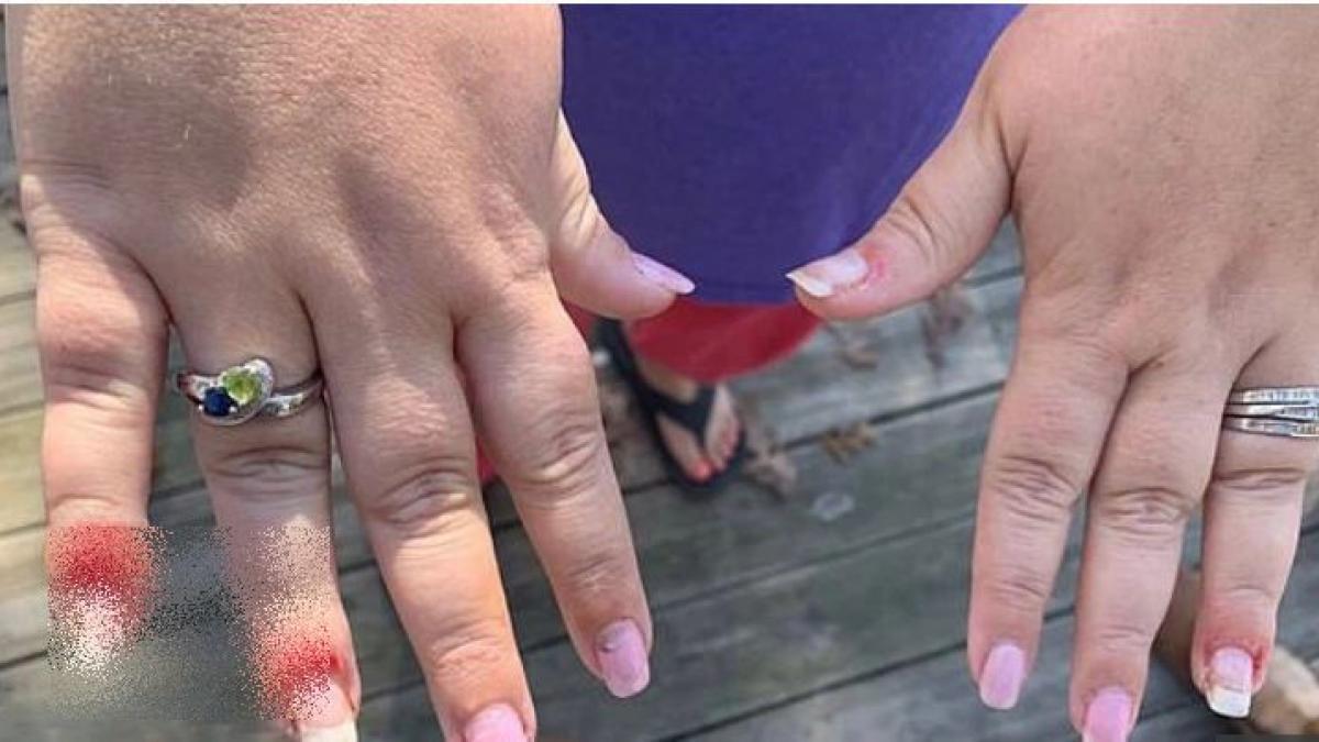 a vrut o manichiura de vis dar s a ales cu un cosmar degete umflate si pline de puroi cum arata