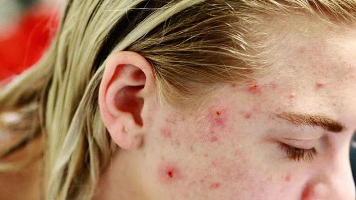 avertismentul unui dermatolog roman stoarcerea unui cos poate grabi dezvoltarea cancerului