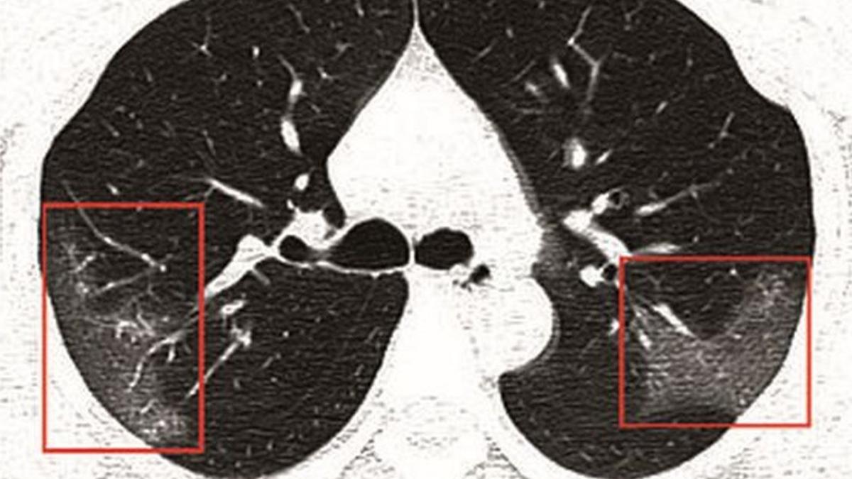 cum arata radiografia pulmonara a unei tinere cu coronavirus