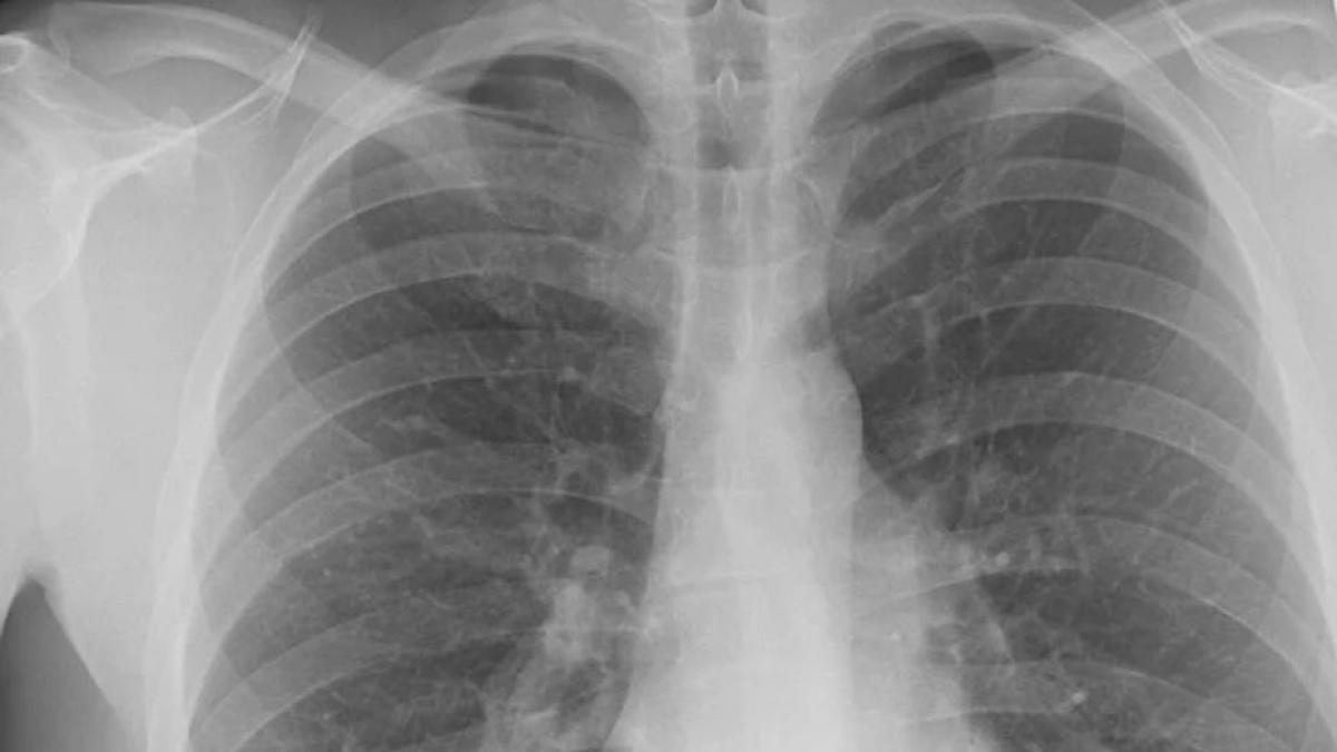 spiridon dumitrescu pneumolog calarasi coronavirus