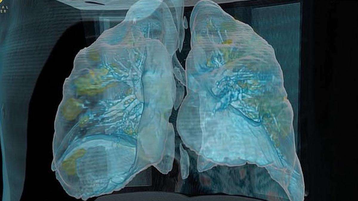 imagini coronavirus patrunde in plamanii unui barbat de 50 de ani
