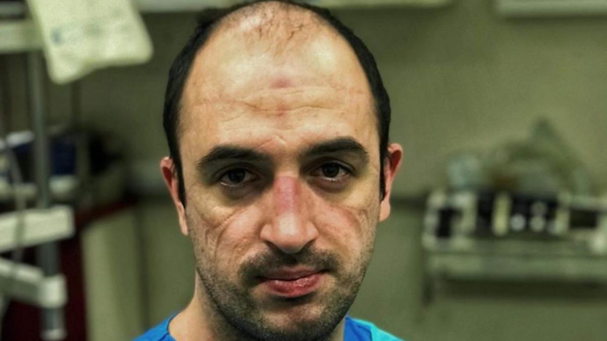 Imaginea unui tânăr asistent după zeci de ore de muncă: obosit și cu semne adânci în față de la masca de protecție