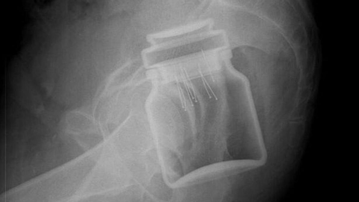 barbat botosani urgenta borcan anus