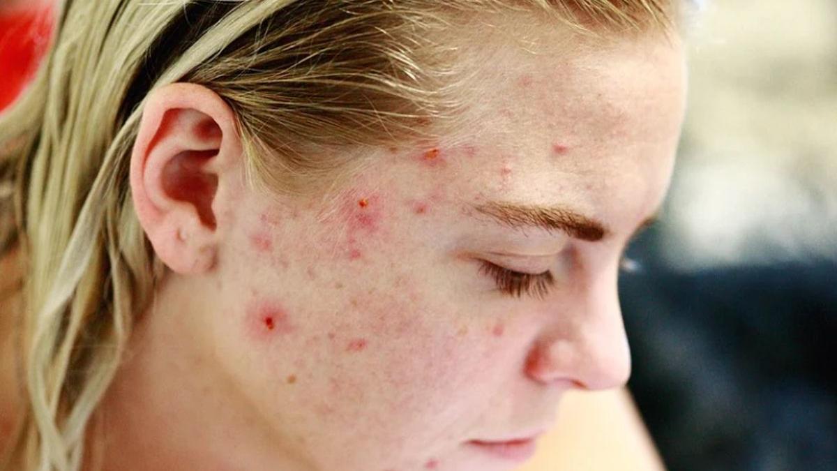 cum sa ai un ten perfect in fiecare zi metoda naturala care te scapa rapid de imperfectiuni