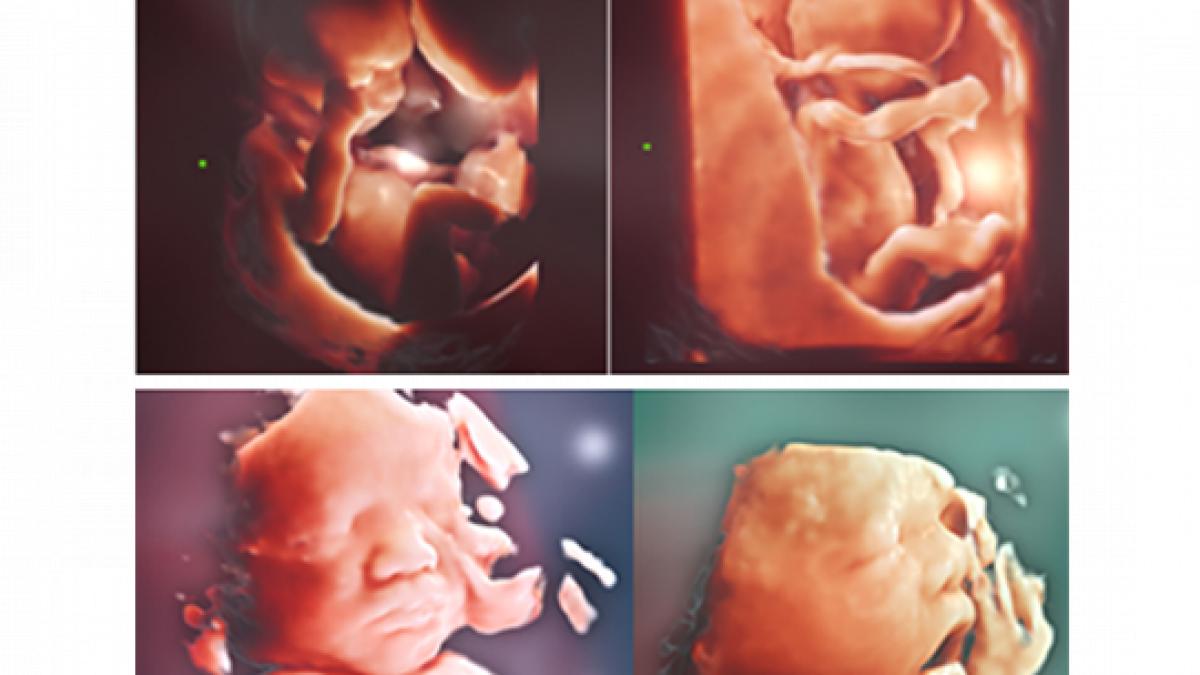 ce trebuie sa stii despre ecografia doppler