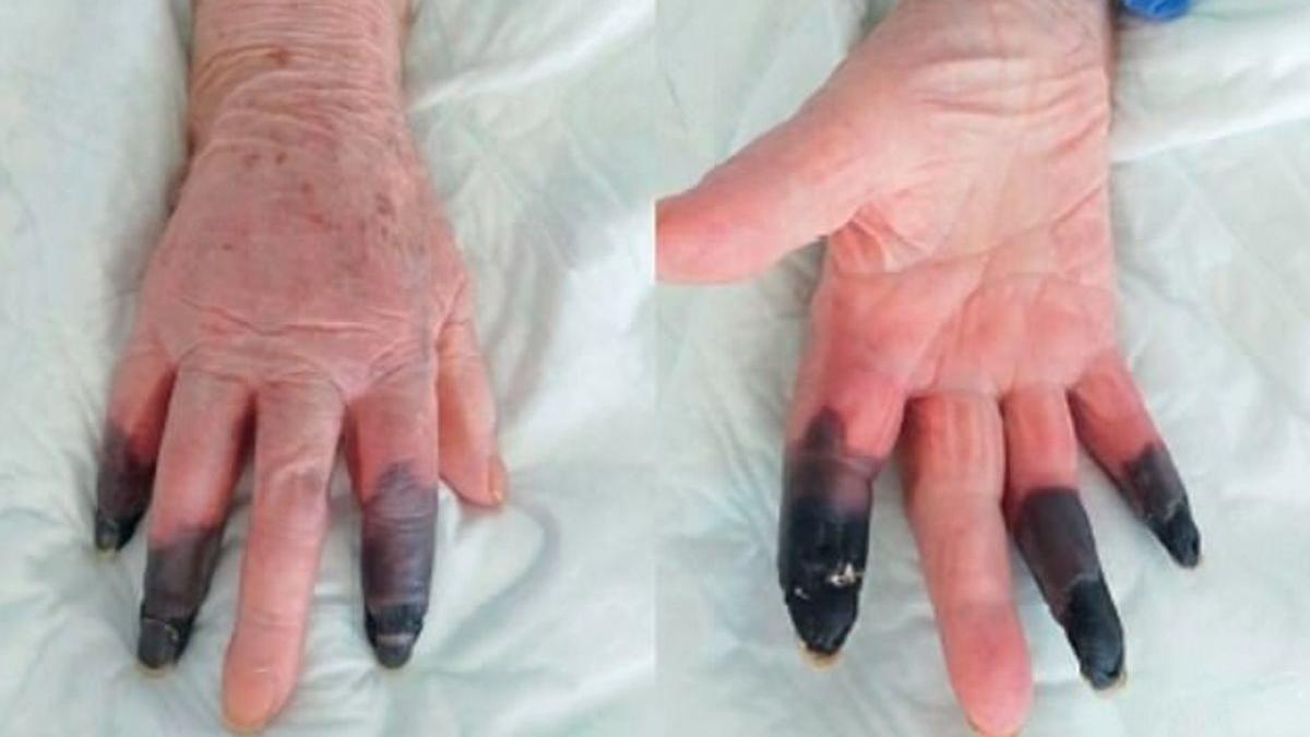 degete amputate coronavirus