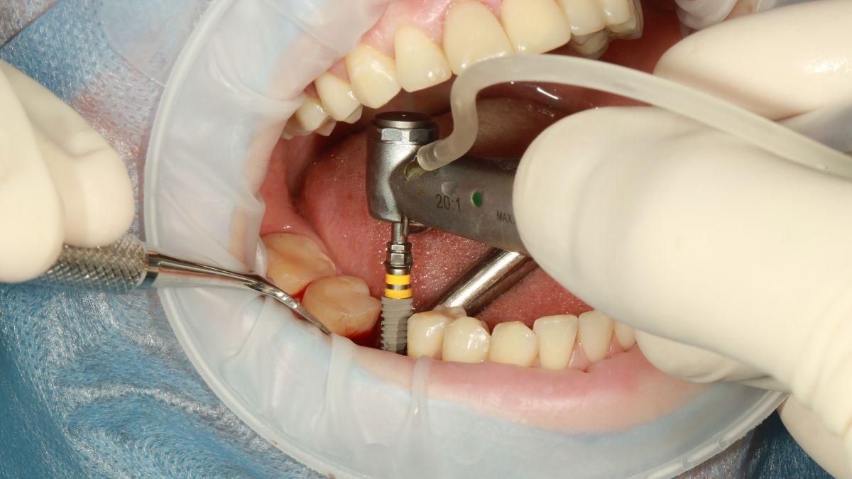 sfat de sanatate implant dentar ada epistatu