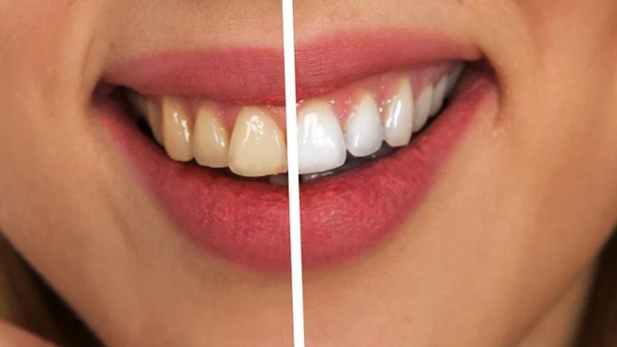 albire profesionala nu strica dintii dr ada epistatu