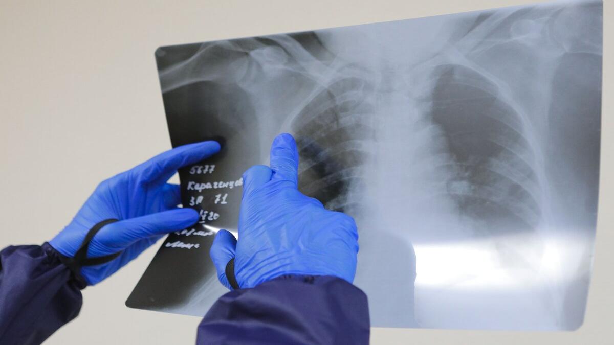 transplant de plamani covid 19 japonia