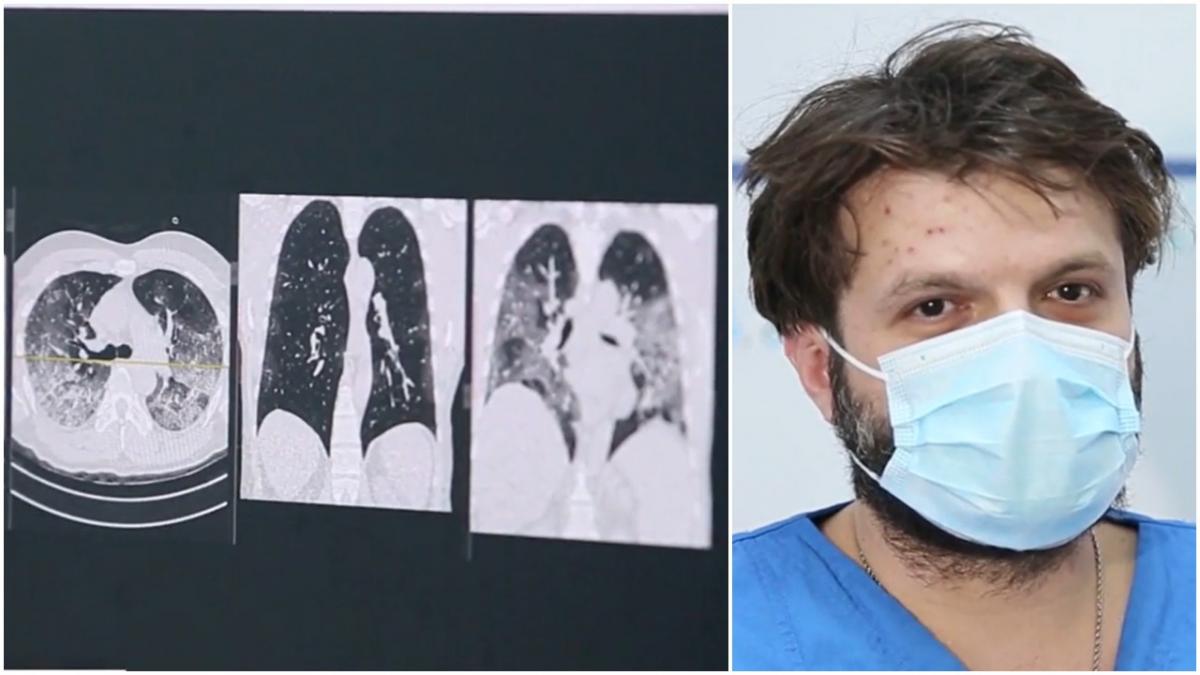 imagini plamani afectati covid proportie de 80