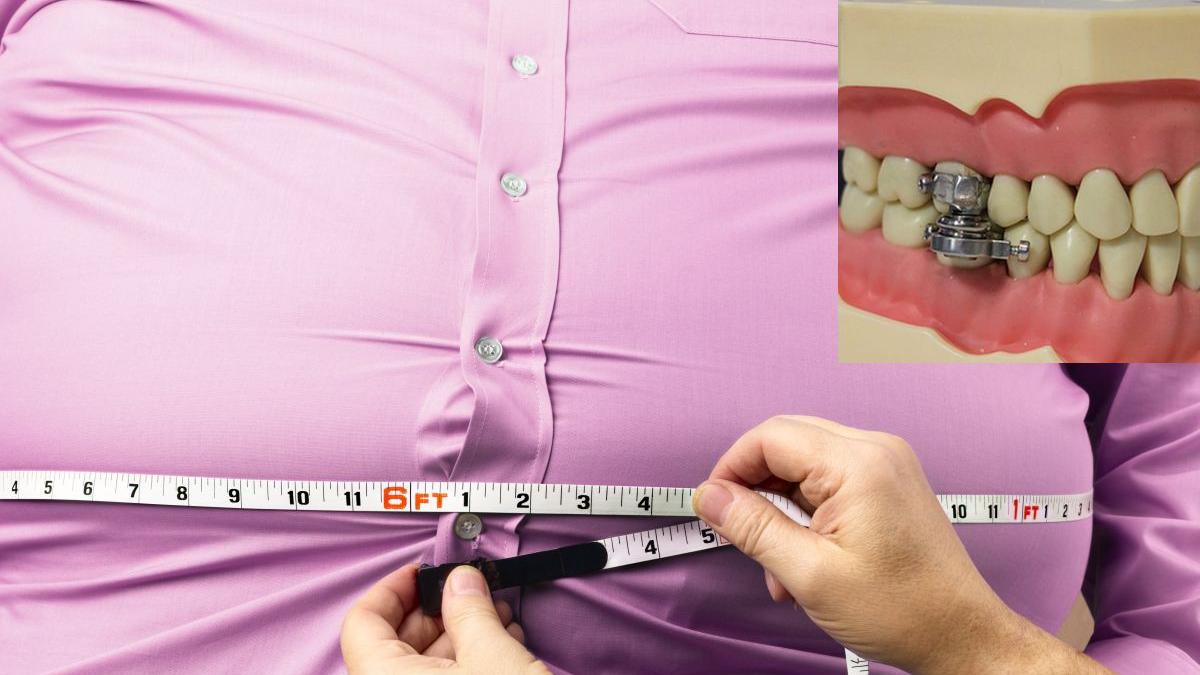 dispozitiv blocare gura magneti dieta slabire obezitate otago leeds