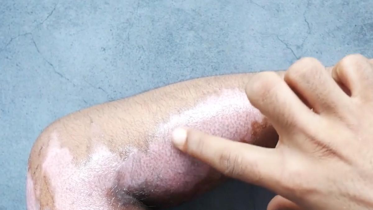 sfat prim ajutor caz arsuri