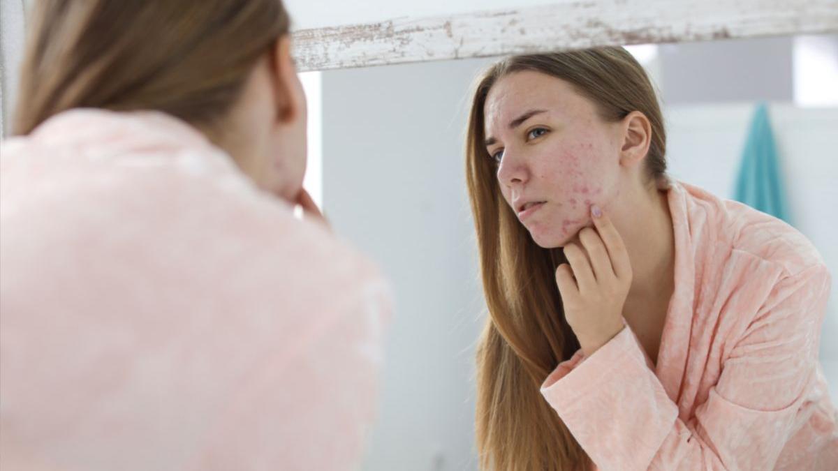 ce poti face pentru a ameliora simptomele acneei