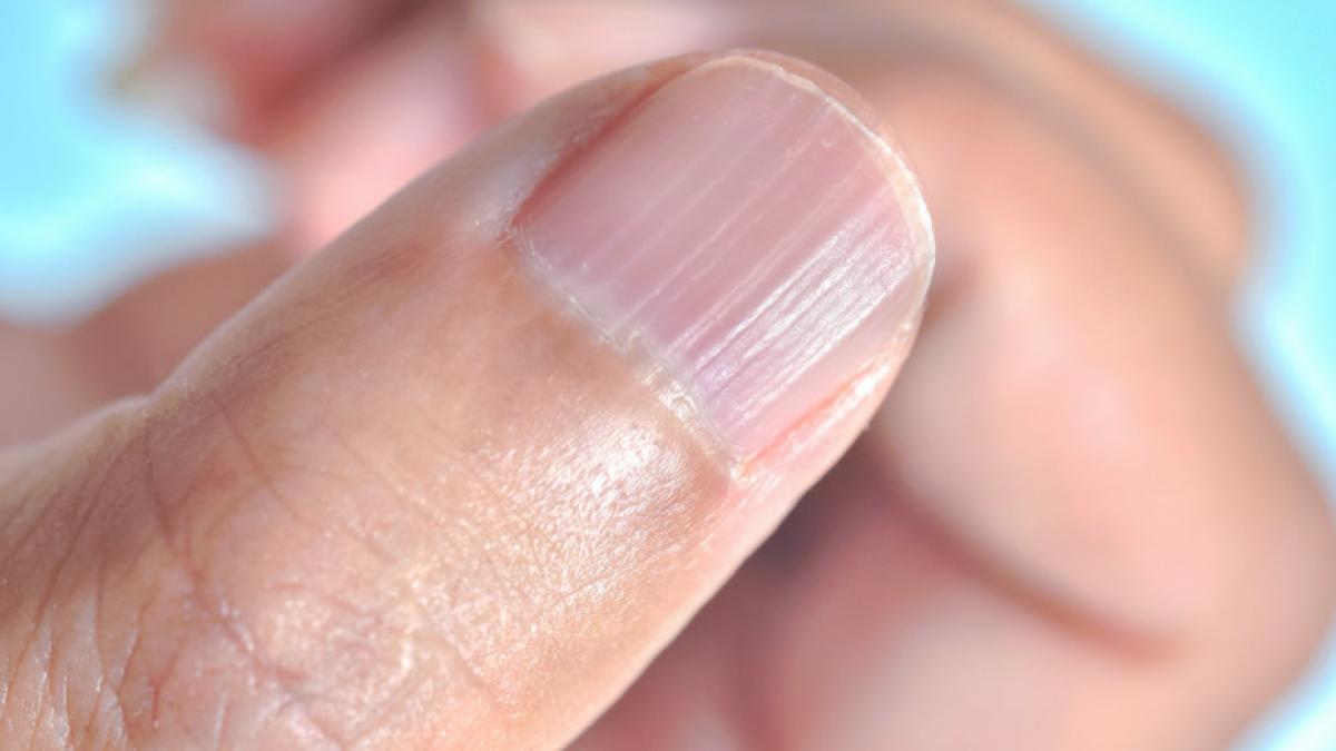 semne unghii indica cancer inseamna incretituri unghii medic