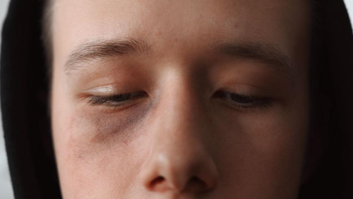 calum courtney 14 ani basildon essex alergic frig soc anafilactic