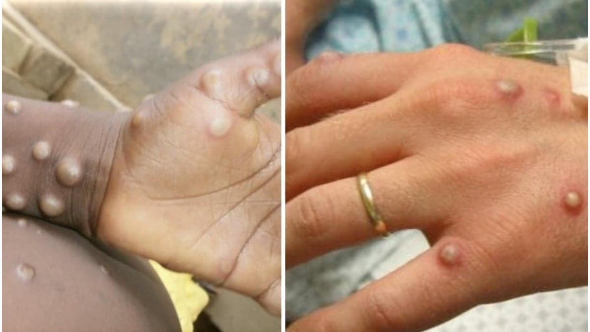 Alte patru persoane din Marea Britanie au fost diagnosticate cu variola maimuțelor. Temeri cu privire la ”răspândirea în comunitate” a virusului