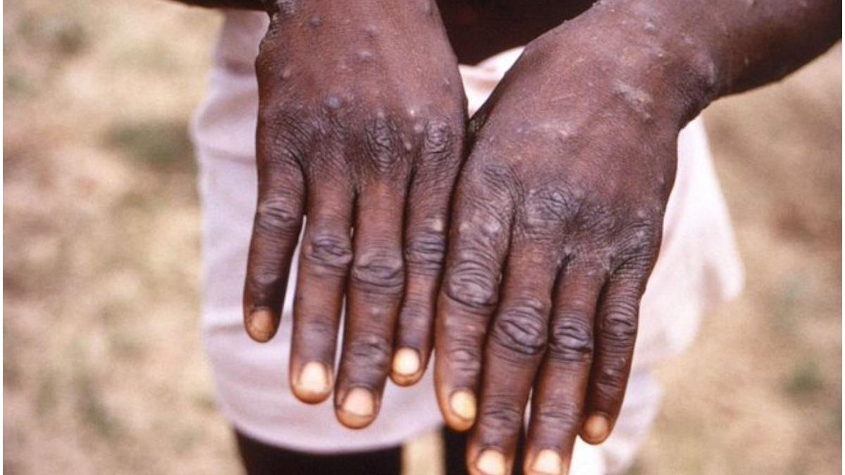 israelul anunta primul sau caz confirmat de variola maimutei