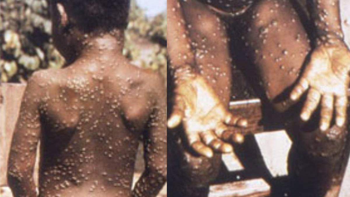 categorie persoane expusa posibiltati ridicate infectare variola maimutei