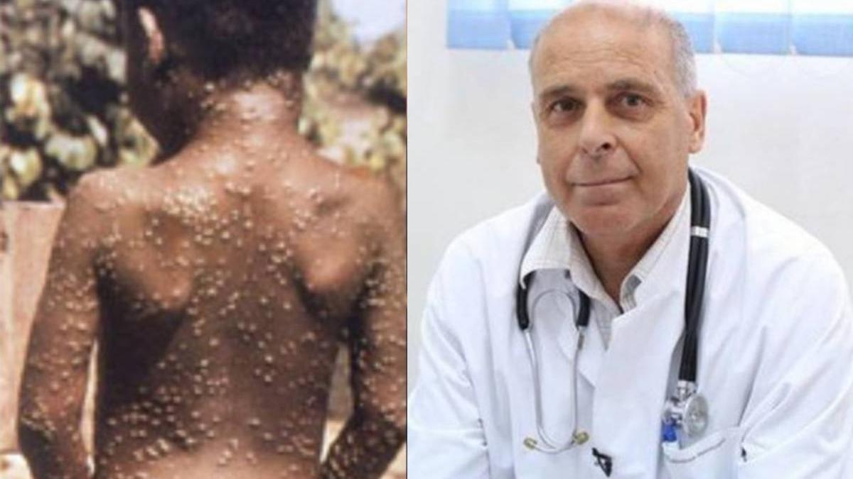 virgil musta variola maimutei