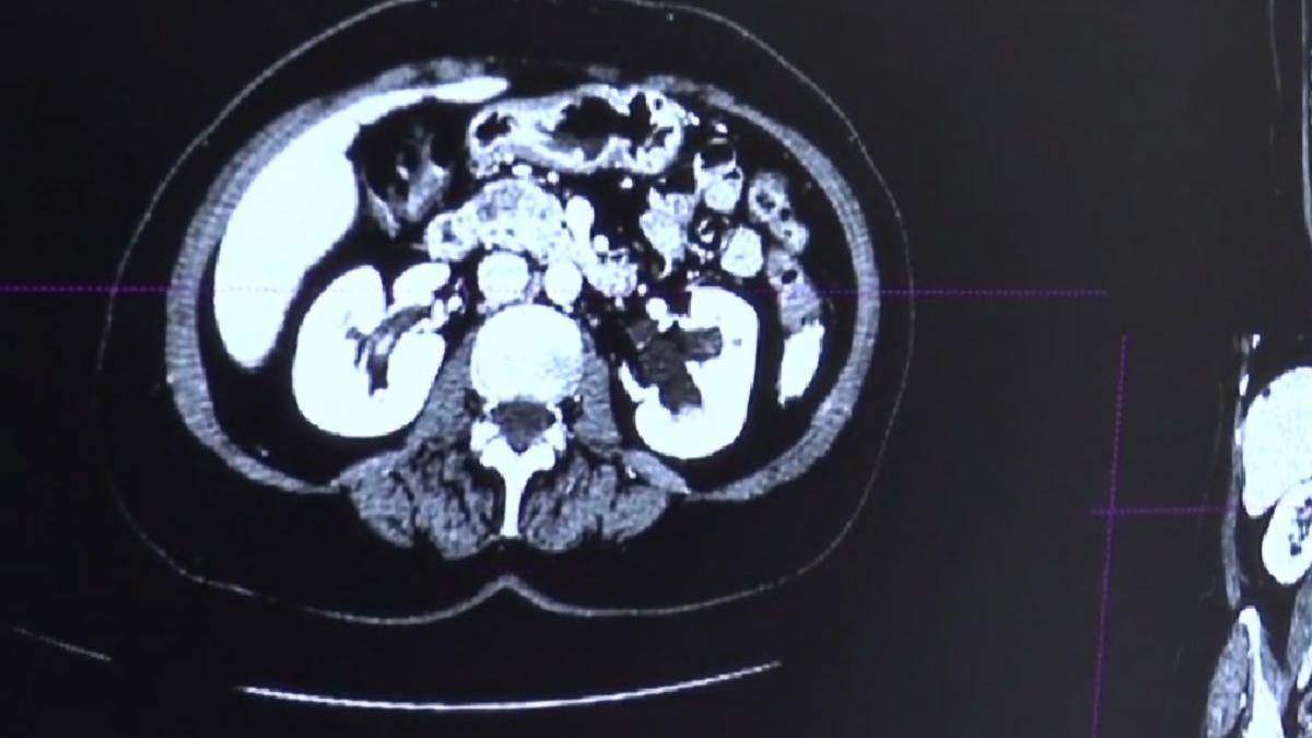 software inteligenta artificala tumori pacienti