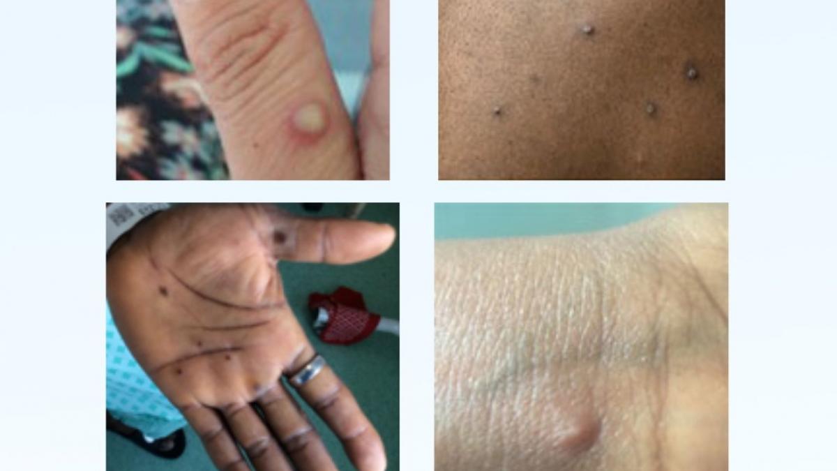 variola maimutei exemple eruptii piele