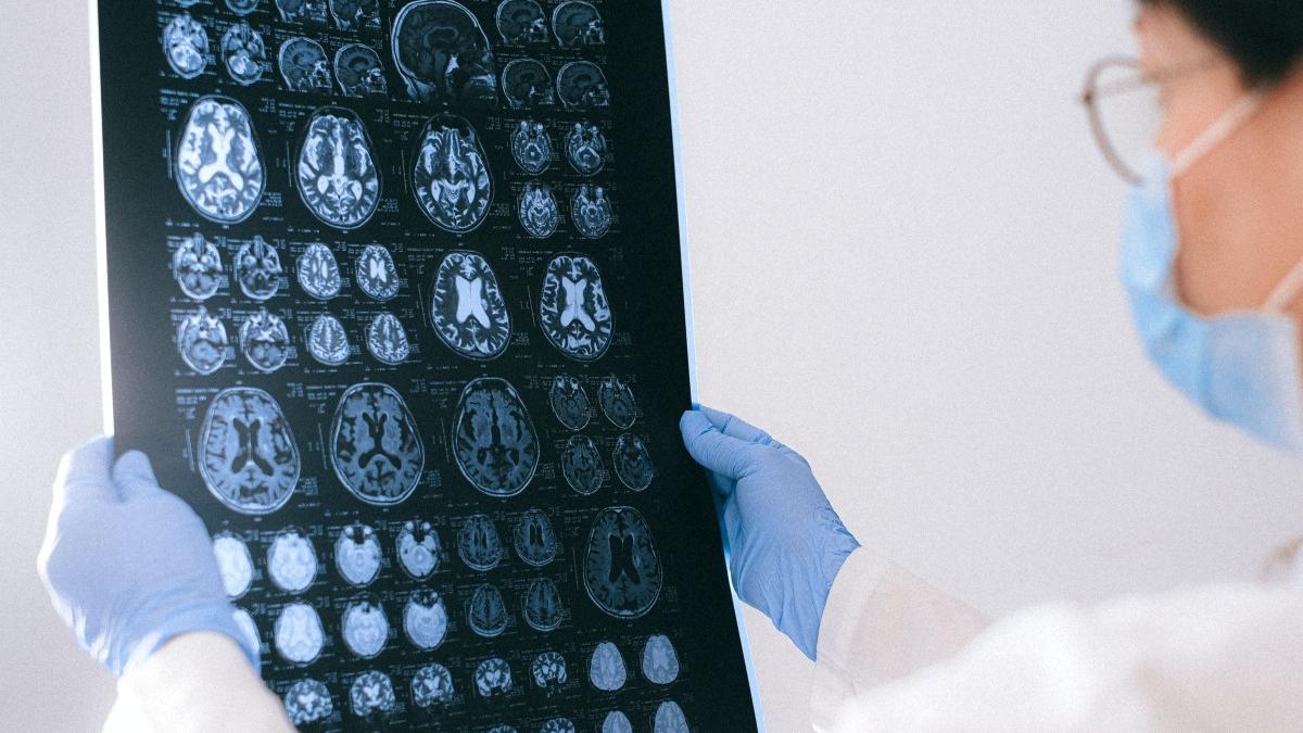 medicament tratament boala alzheimer