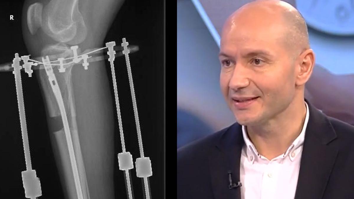 operatie alungire picioare dr ene