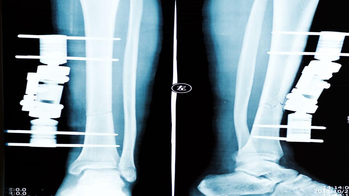 operatie estetica moda barbati chinuri