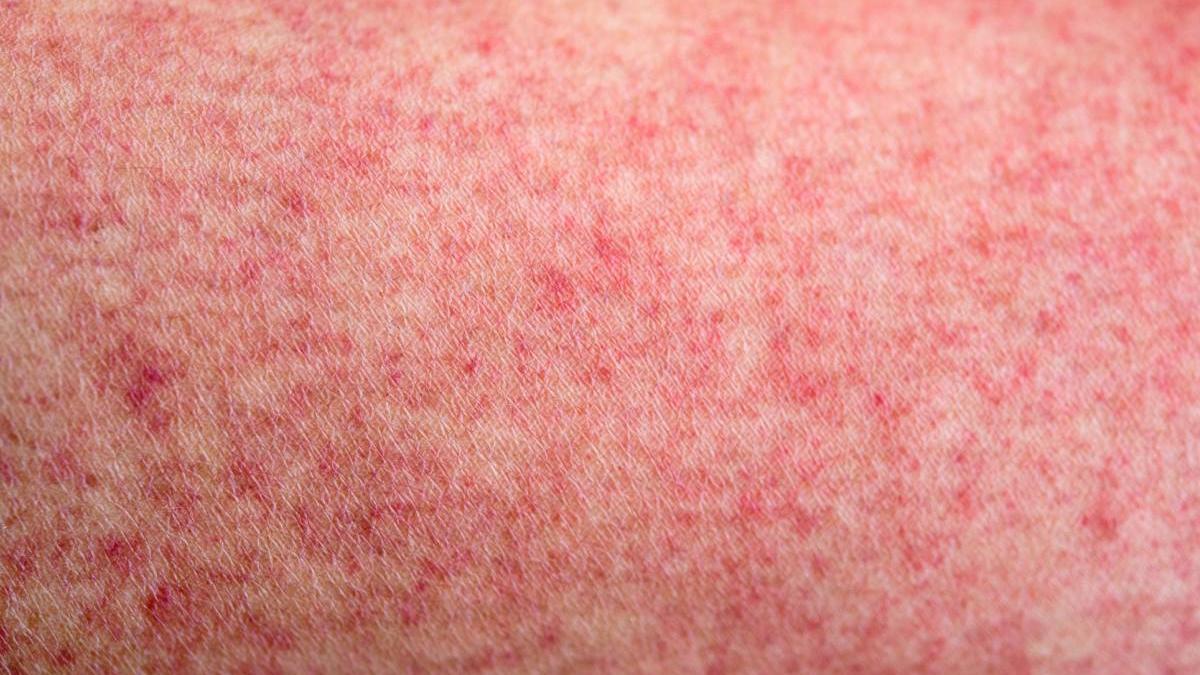 copii morti marea britanie infectie bacterie scarlatina