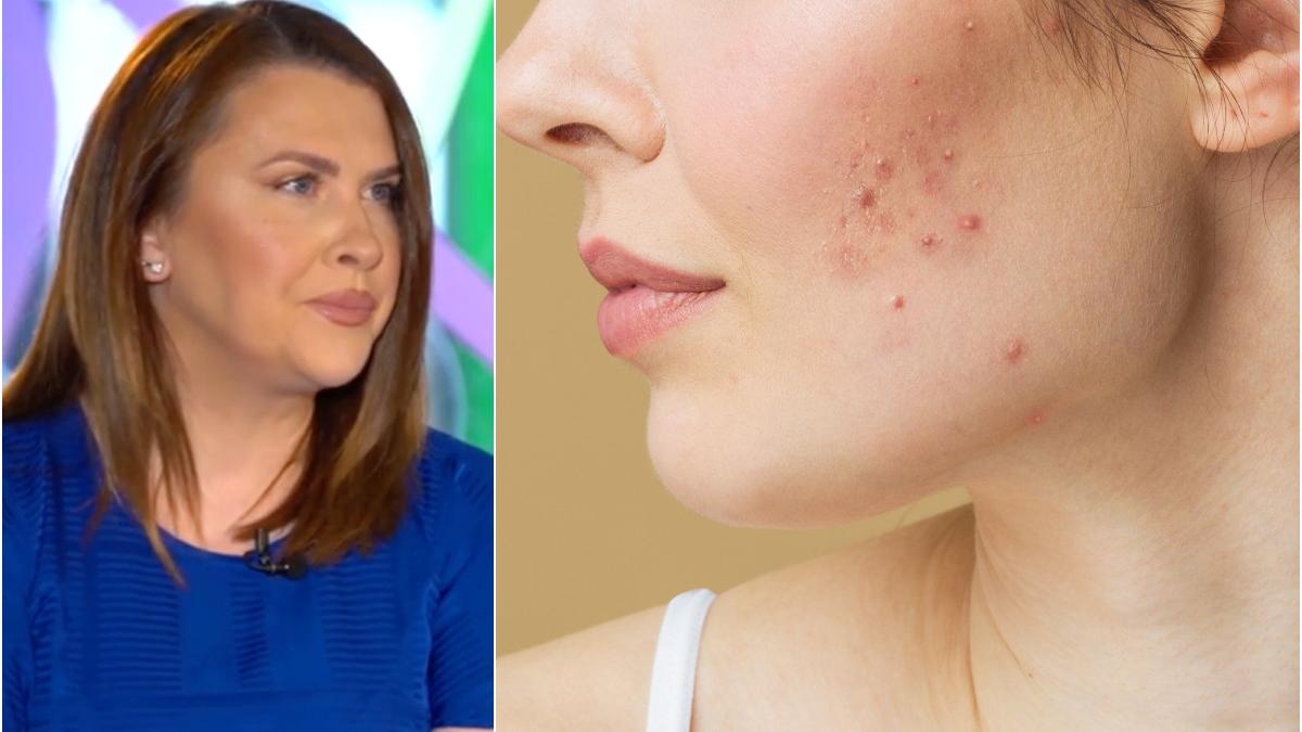 acnee adulti cauze alimente cum scapam de urme