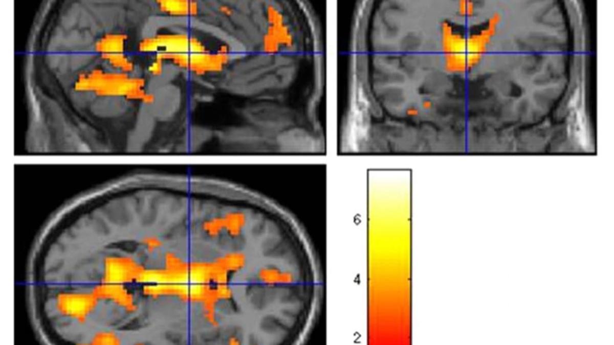 medic neurolog roman arata cum este afectat creierul gelozie