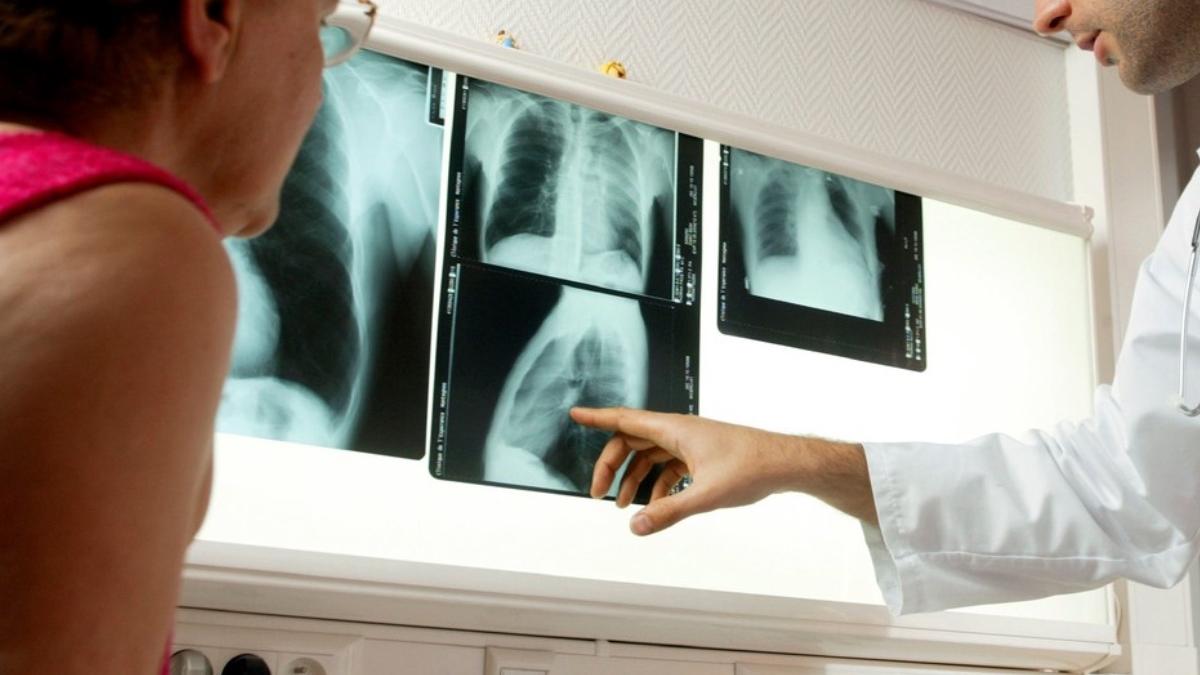 cancer pulmonar poate fi prezis 6 ani inainte sa apara algoritm ai