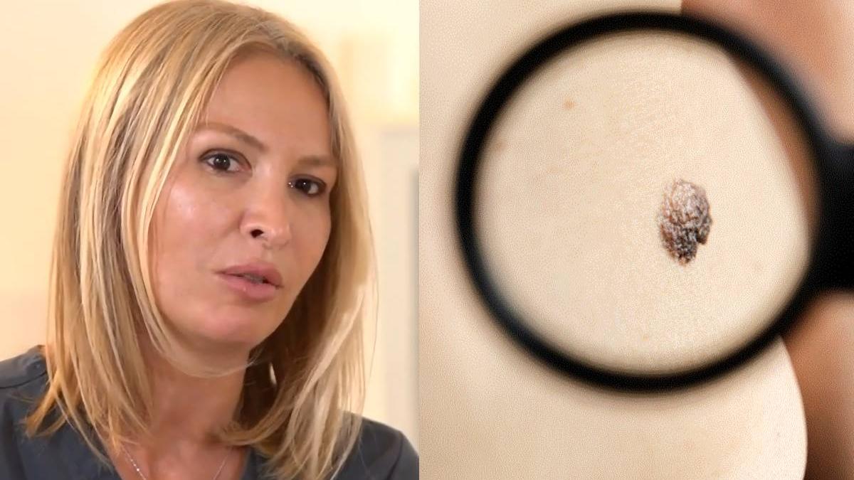 cum monitorizam corect alunitele acasa semne arata alunita cancerigena