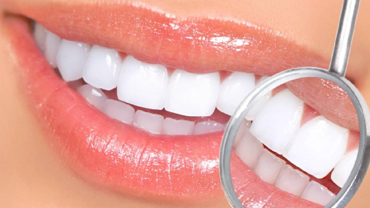 albirea dentara o solutie la indemana oricui