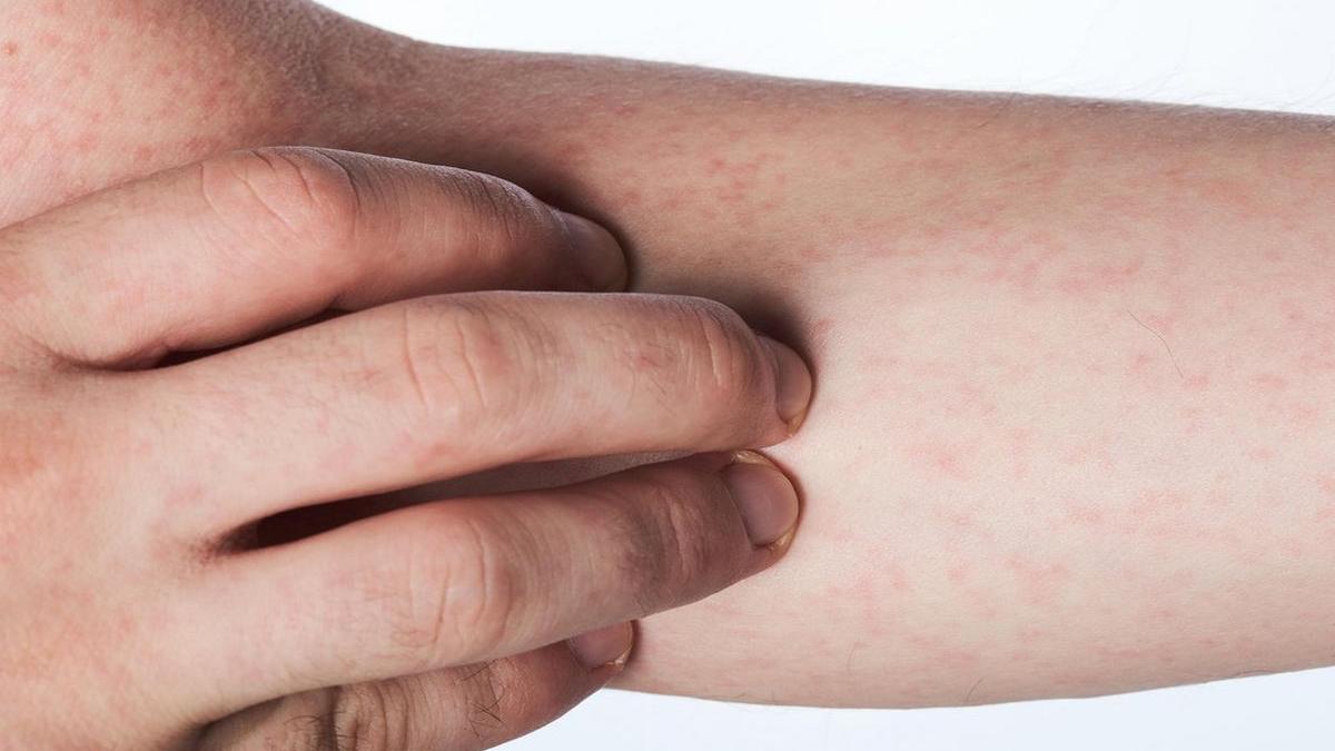 simptome rujeola semnul koplik